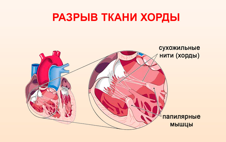 Пролапс митрального клапана                (пролабирование митрального клапана, разрыв папиллярных мышц, барлоу синдром, синдром пролапса митрального клапана)