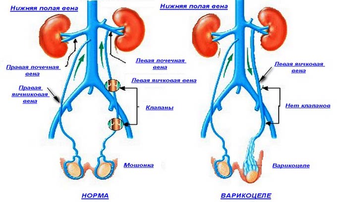 Лечение варикоцеле презентация