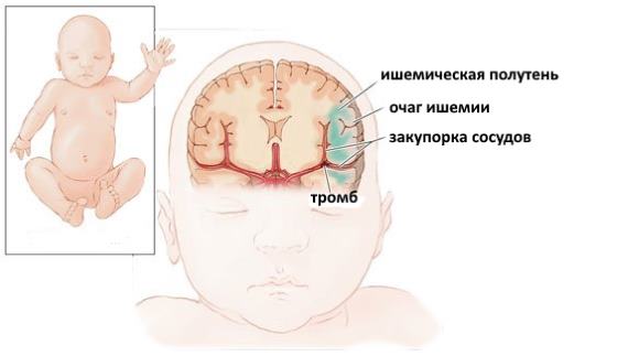 Ультразвуковое исследование (узи) головного мозга