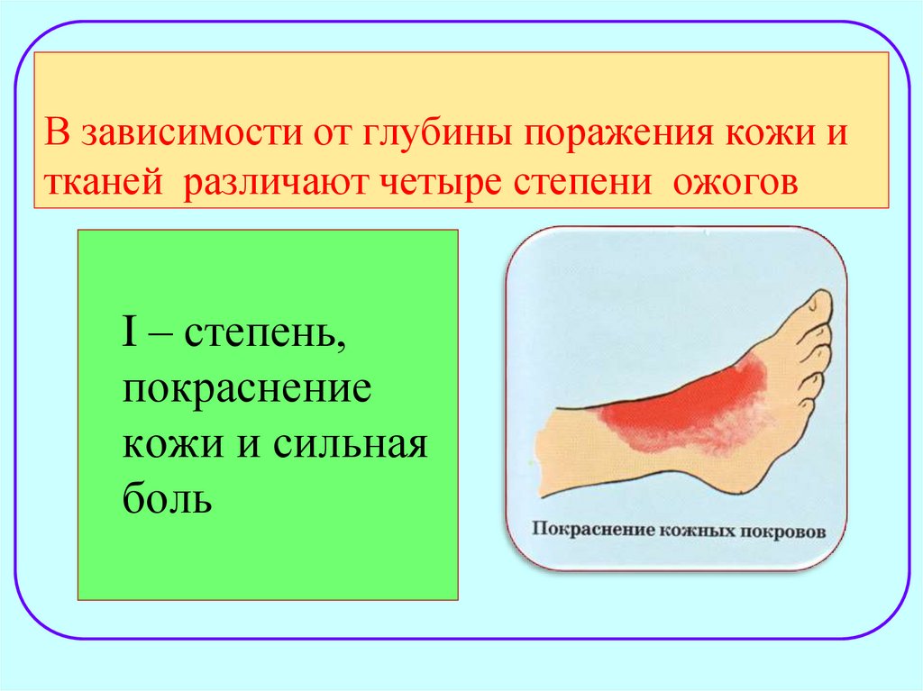 Ожог кипятком в домашних условиях: первая помощь детям и взрослым